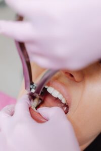 Tør alveole (dry socket): symptomer, behandling og forebyggelse